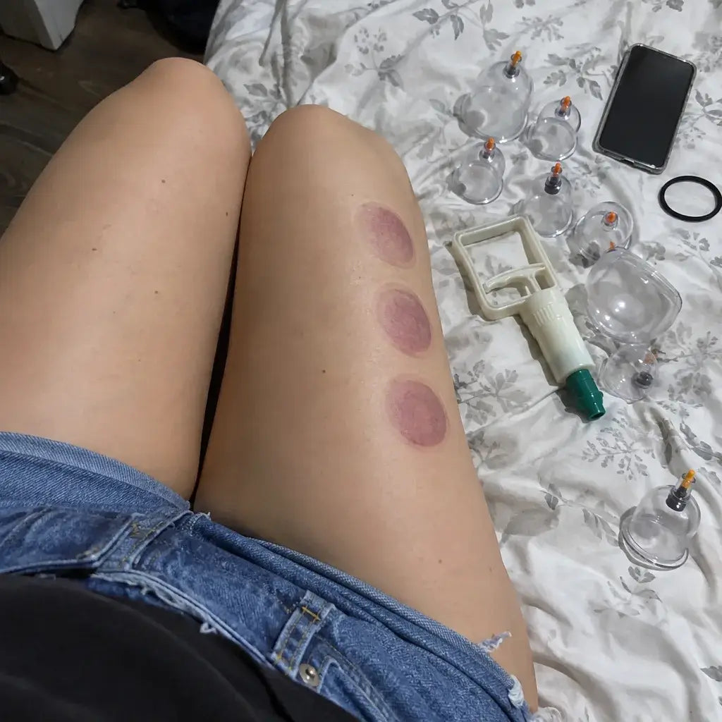 Manual cupping set with pump